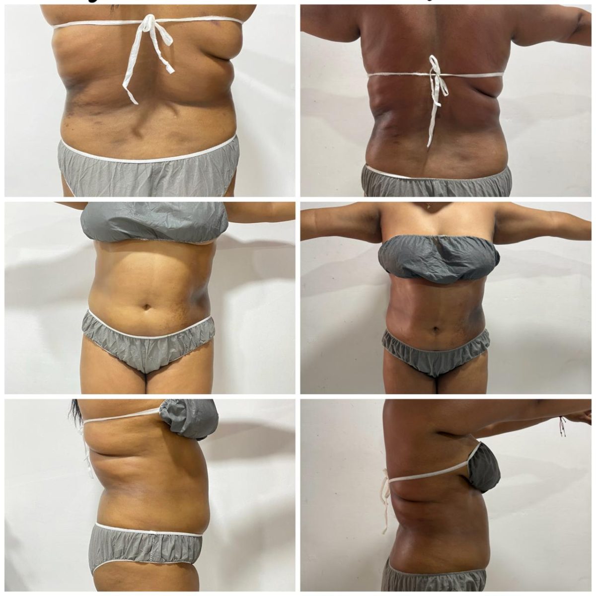 Antes despues tratamiento corporal abdomen — resultado por Heidy Yohana Diaz Perez, cosmetóloga en Montelíbano, Córdoba